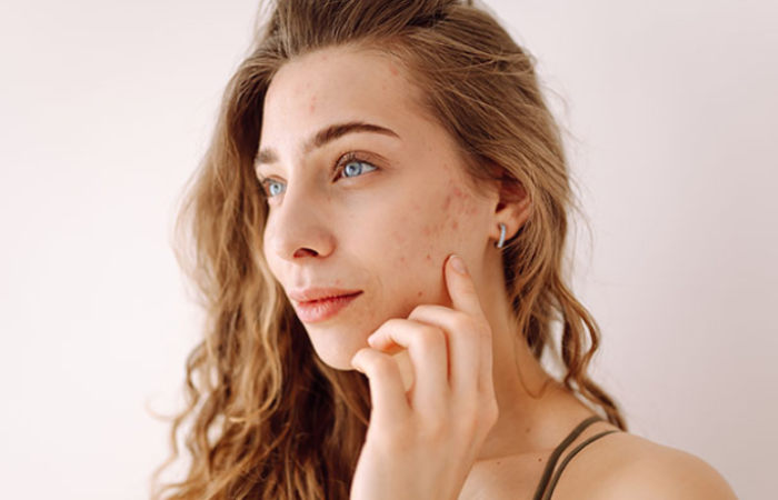 Acne Treatment Cape Town